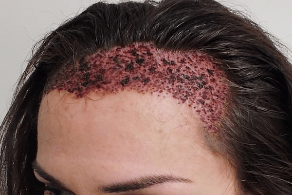 کاشت مو با سلولهای بنیادی