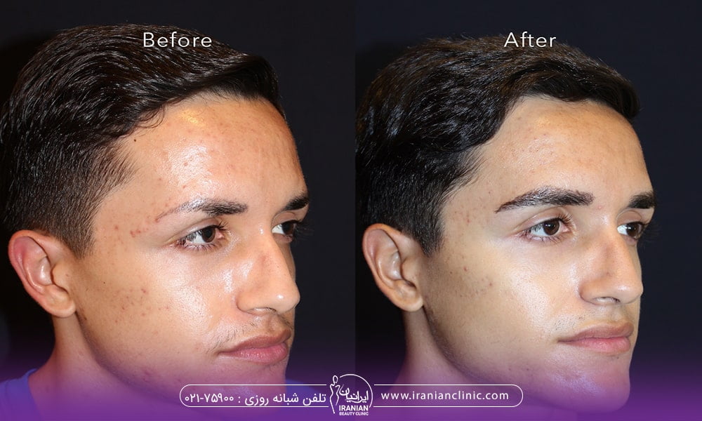 بهترین روش پر پشت شدن ابرو مردانه