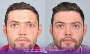 کاشت ابرو مردانه - نمونه قبل و بعد کاشت ابرو طبیعی مردانه