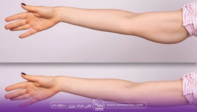 رفع افتادگی بازو - قبل و بعد جراحی زیبایی بازو