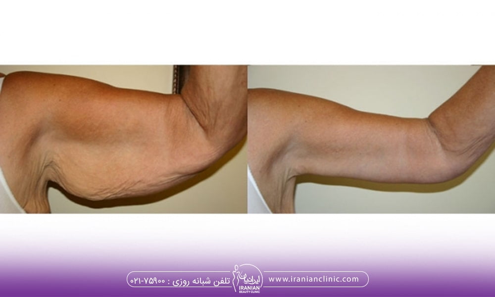 انواع جراحی زیبایی بازو