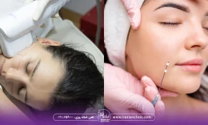 هایفوتراپی بهتر است یا لیفت با نخ