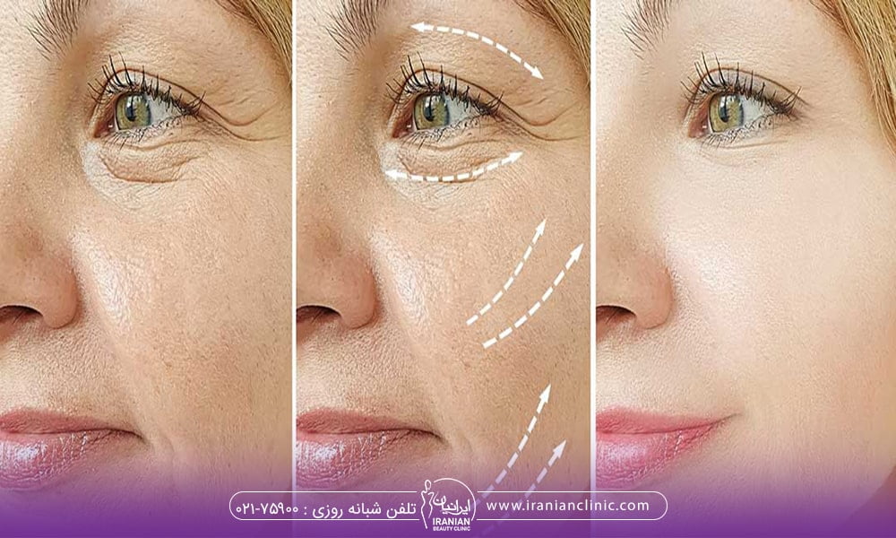 لیفت صورت با نخ یا تزریق چربی - انتخاب روش مناسب برای رفع خطوط صورت