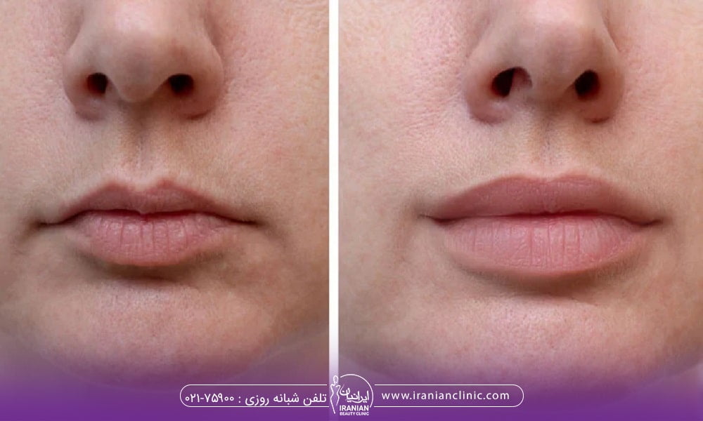 تزریق چربی به لب بهتر است یا تزریق ژل