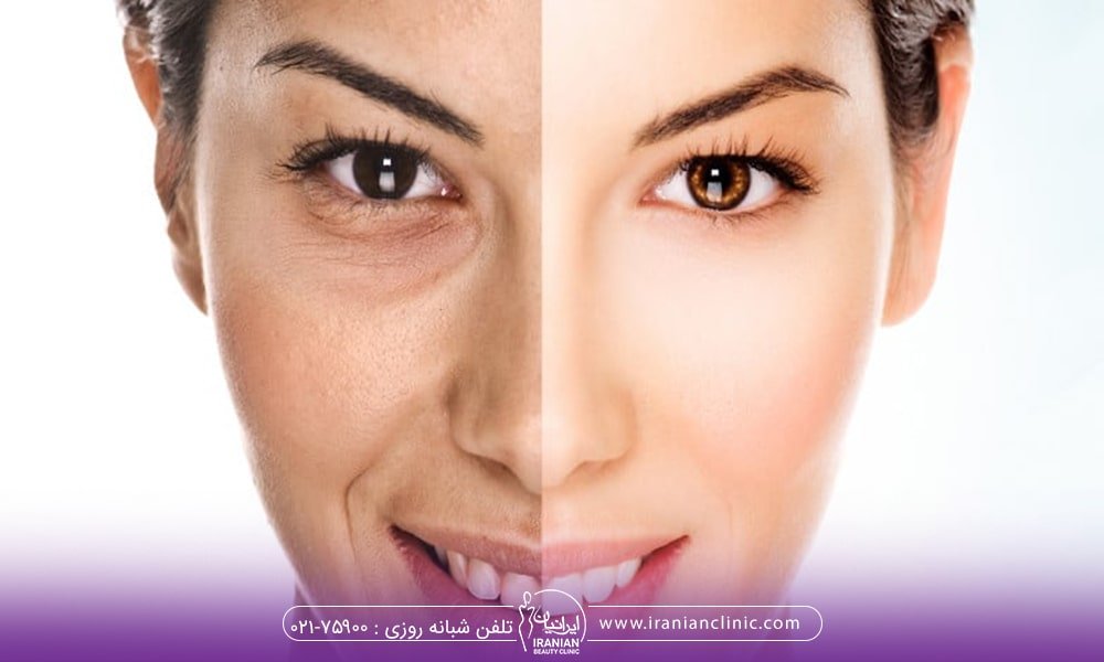 مقایسه تزریق چربی با تزریق ژل