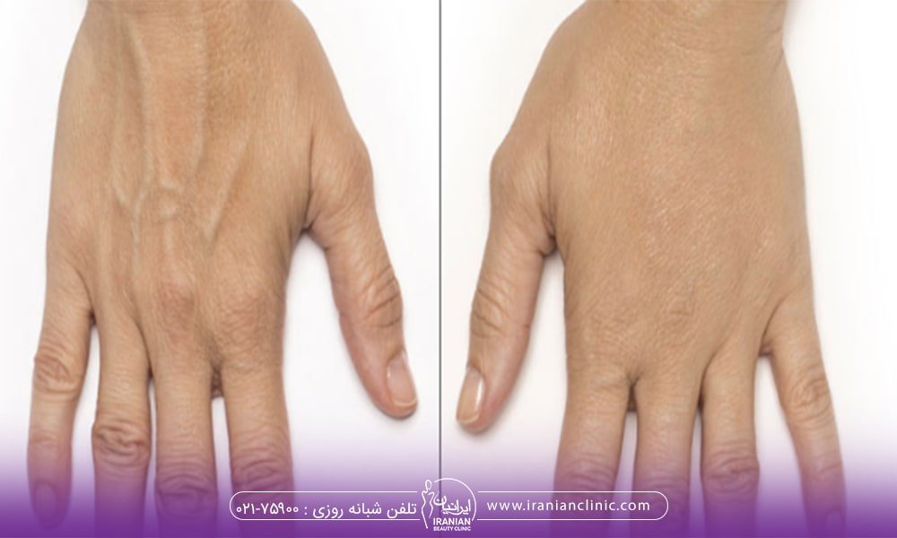 هایفوتراپی دست چگونه انجام می شود؟