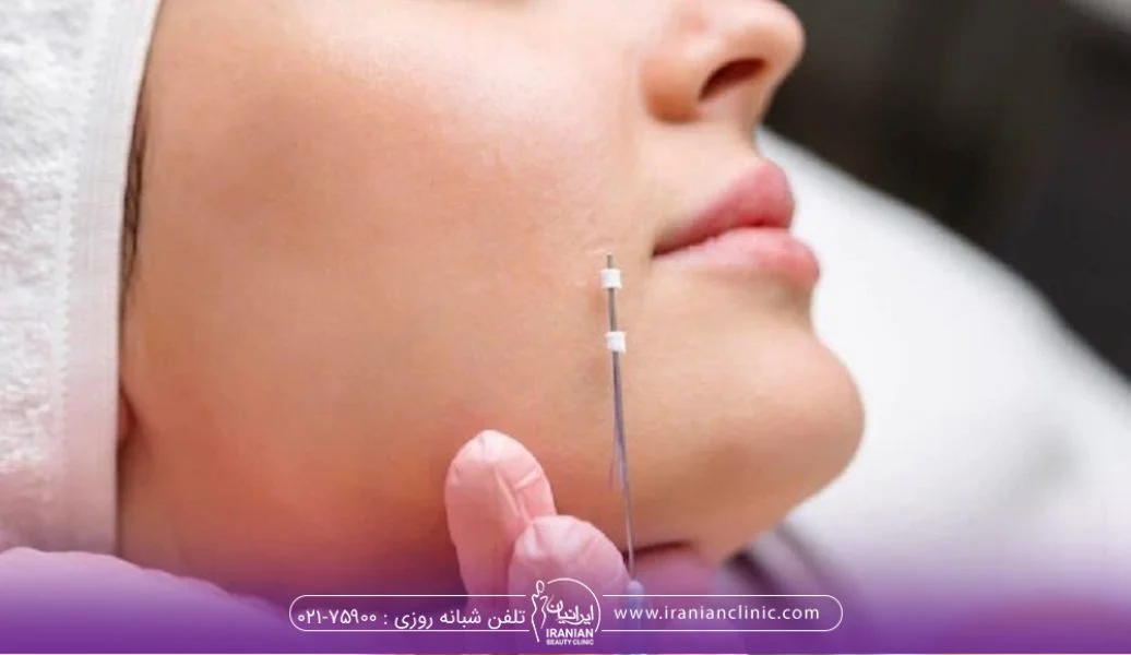 روش های لیفت با نخ