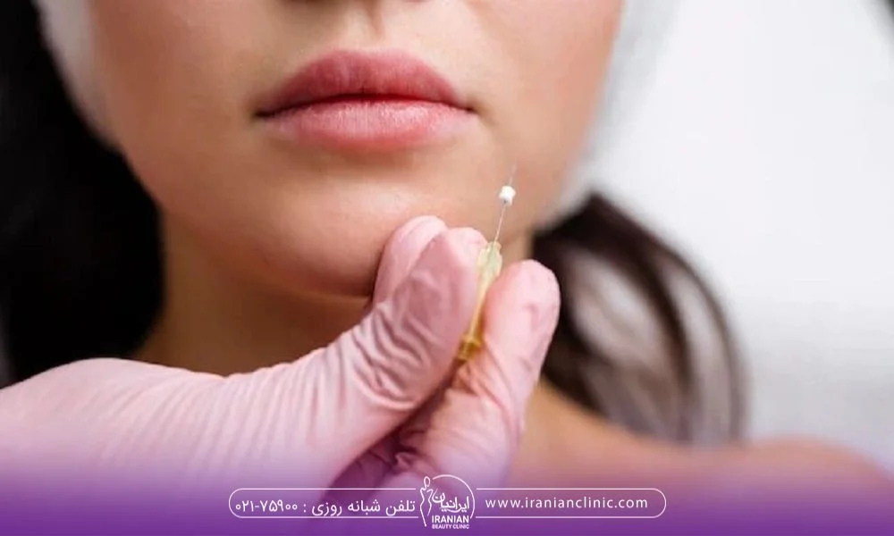 کاربردهای لیفت نخ