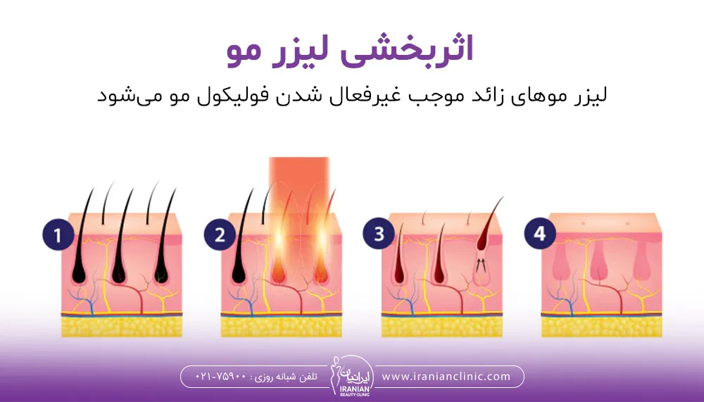 چرخه از بین رفتن مو توسط لیزر
