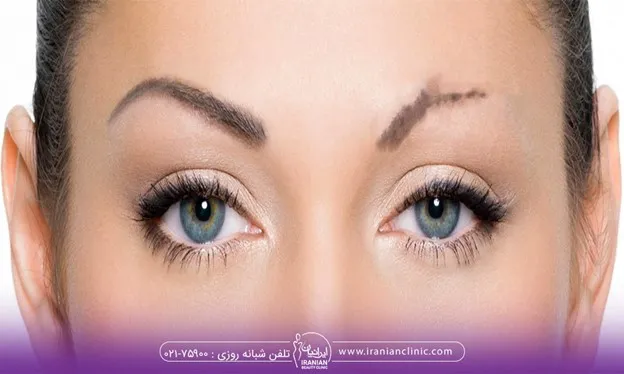 مراقبت های مهم بعد از کاشت ابرو