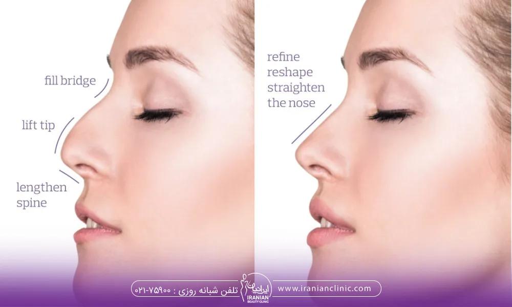 کاندید مناسب برای هایفوتراپی بینی