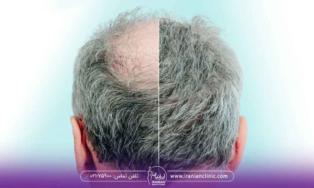 عکس قبل و بعد از کاشت مو مرد با موهای خاکستری