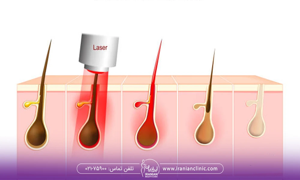 چرخه ریزش مو بعد از لیزر موی زائد