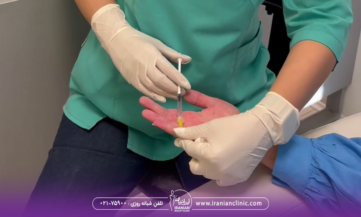 تزریق بوتاکس کف دست