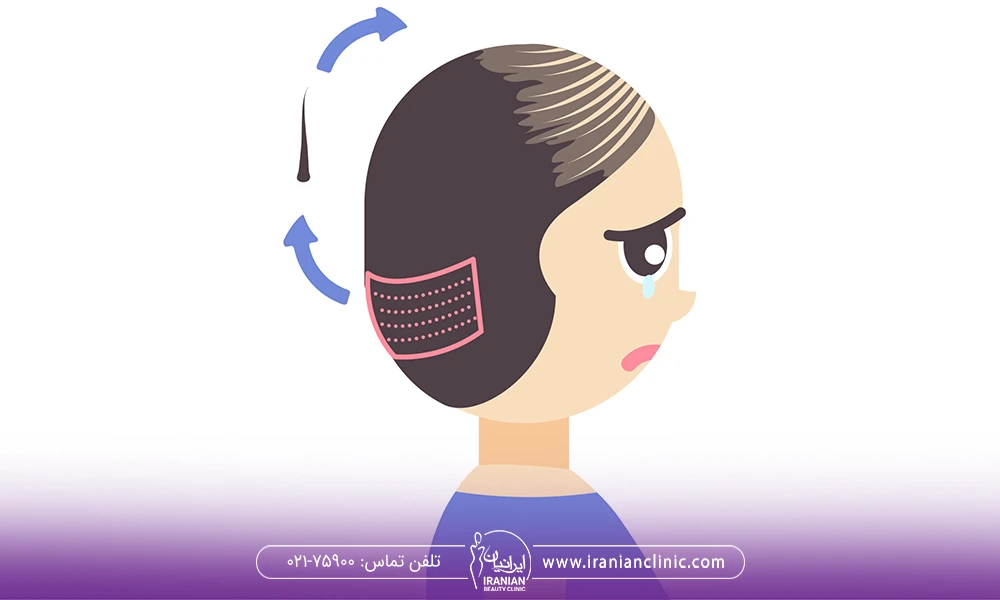 عکس پیوند مو از پشت سر