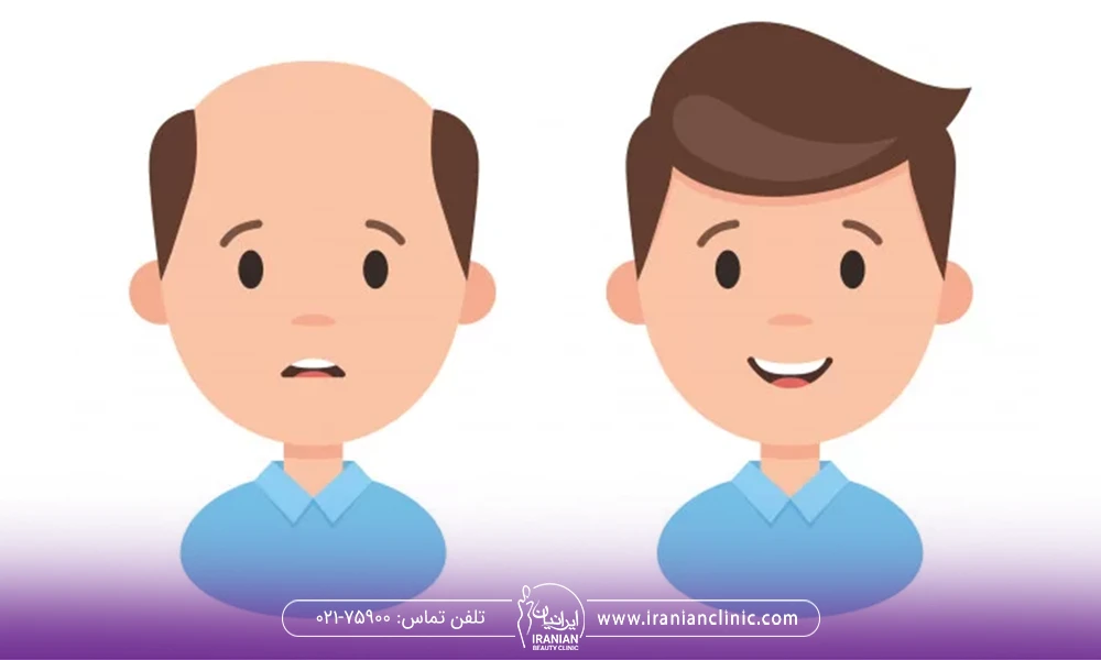 عکس وکتور از کاشت مو به سر بدون مو - کاشت مو