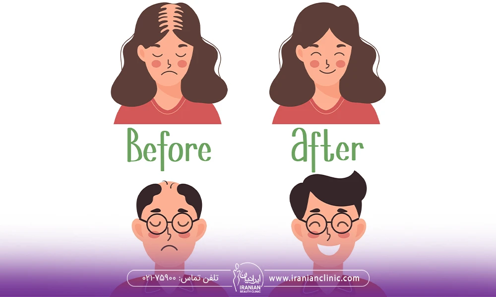 عکس before و after کاشت موی زن و مرد