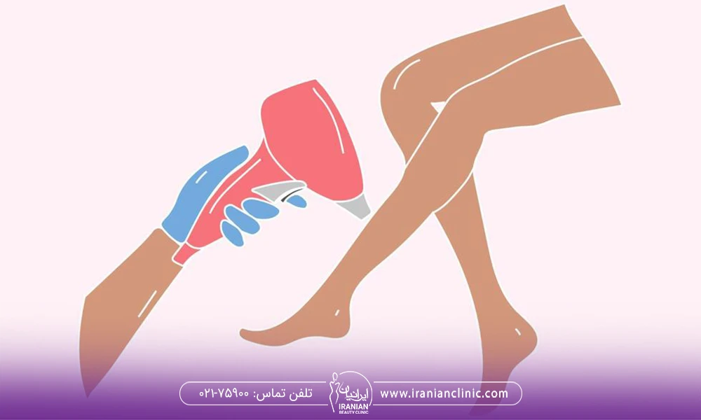 لیزر موهای زائد برای پا
