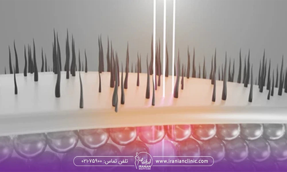 اشعه دستگاه لیزر روی پوست و موی فرد