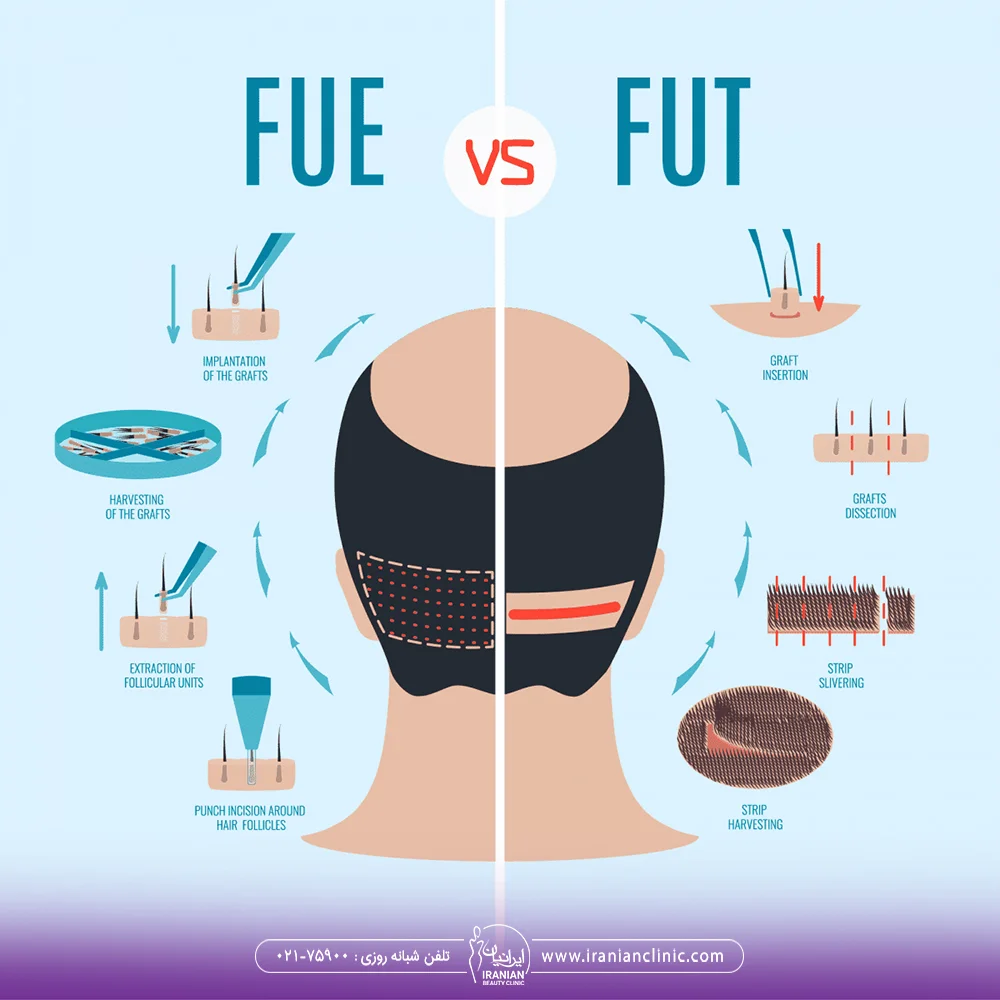 انواع روش های برداشت مو از پشت سر و تفاوت روش fut و fue