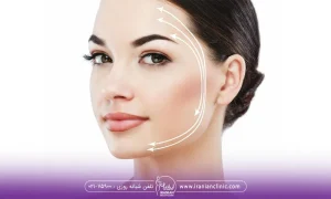 When is the best age for a thread lift