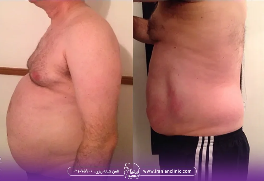 عکس قبل و بعد مردی که با دستگاه کویتیشن لاغر شده است - دستگاه لاغری کویتیشن