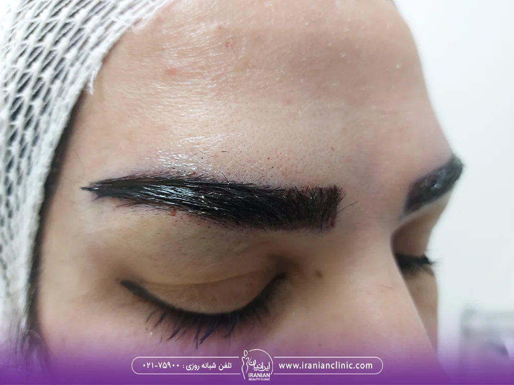 عکس نتایج کاشت ابرو زن جوان