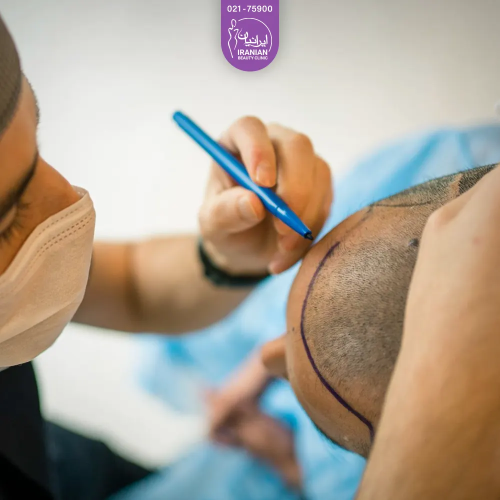 تصویر مردی در حال مشخص کردن ناحیه کاشت موی سرو و کسی که می خواهد کاشت مو انجام دهد