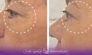 خانمی در حال هایفوتراپچی دور چشم برای از بین بردن چروک دور چشم وتیرگی ان، هایفوتراپی دور چشم