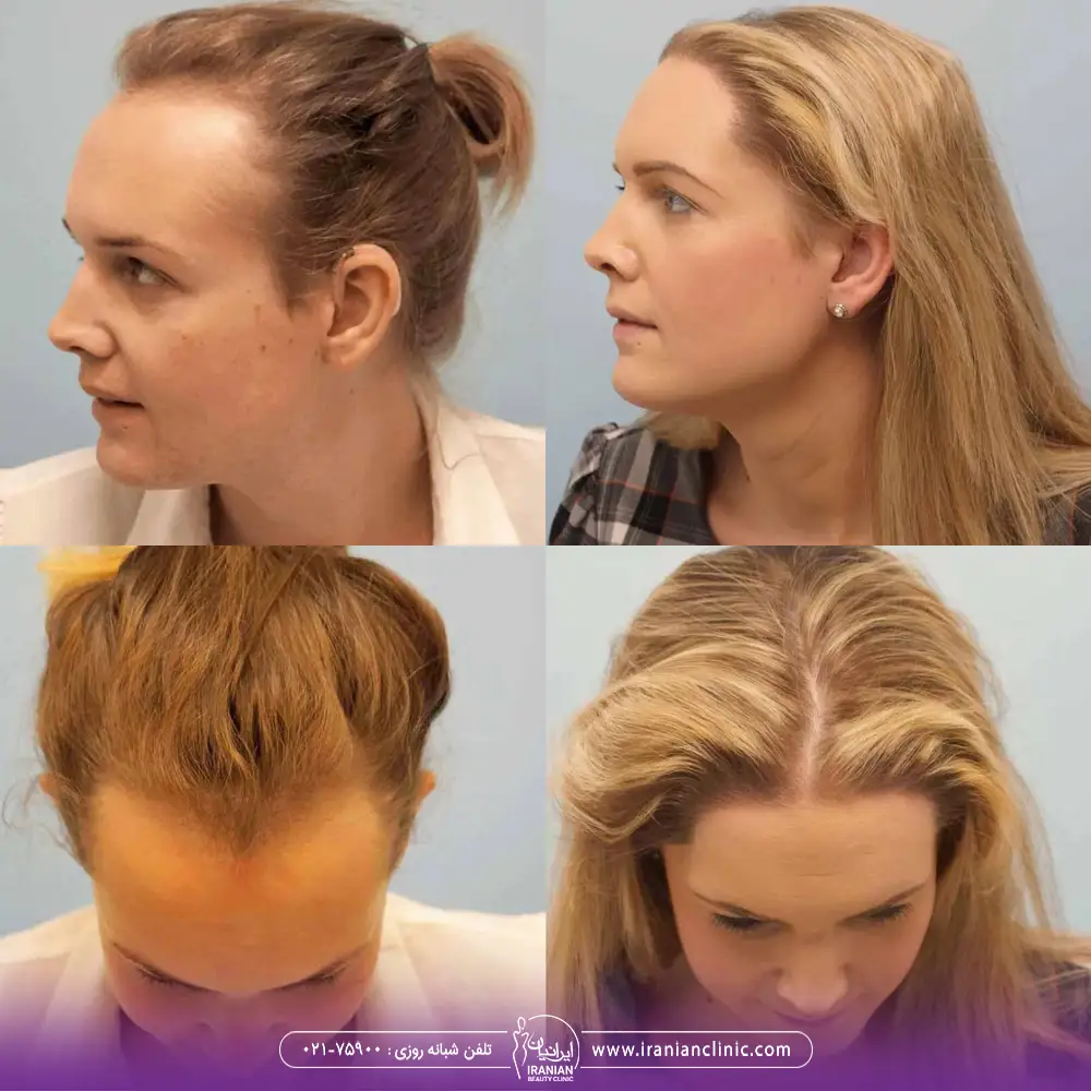 تصویر قبل و بعد کاشت مو برای زن پیشانی بلند