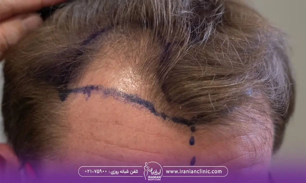 عکس مردی که موهای کم پشتی دارد و پزشک خط رویش او را با ماژیک روی سرش علامت گذاری کرده است