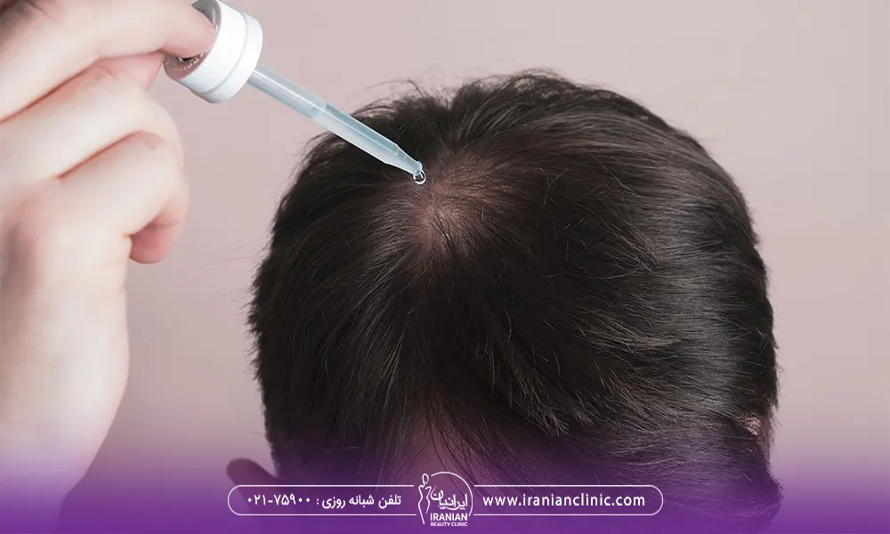 عکس مردی که روی موی سر خود از ماینوکسیدیل استفاده می کند