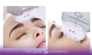 هایفوتراپی بینی چیست و چه تأثیری در فرم بینی دارد؟