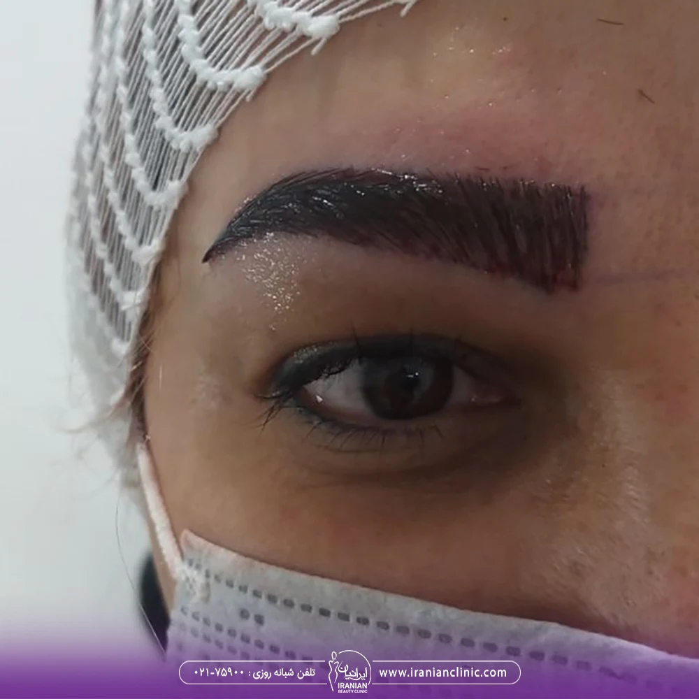عکس از ابروی کاشته شده سمت راست