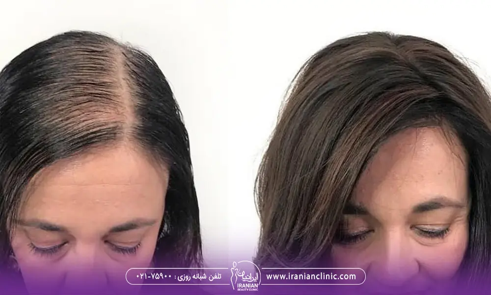 عکس یک زن که ریزش مو داشته است و سپس ریزش موی اون درمان شده است