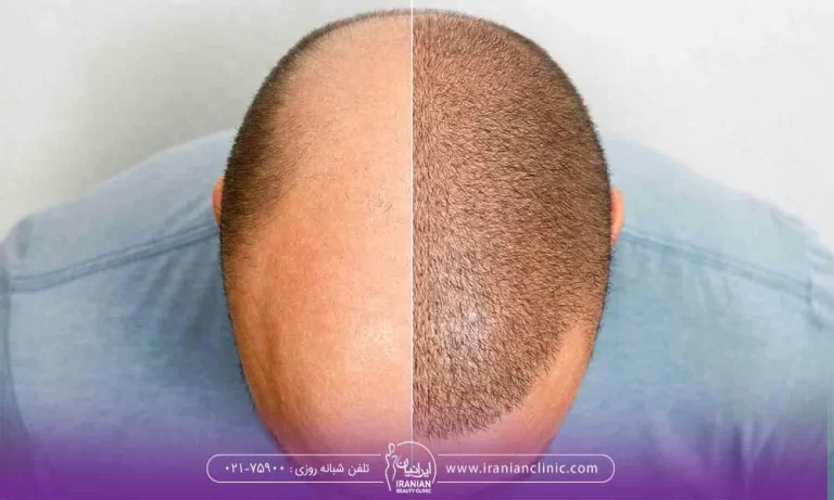 تصویر قبل و بعد کاشت مو برای موهای کم پشت