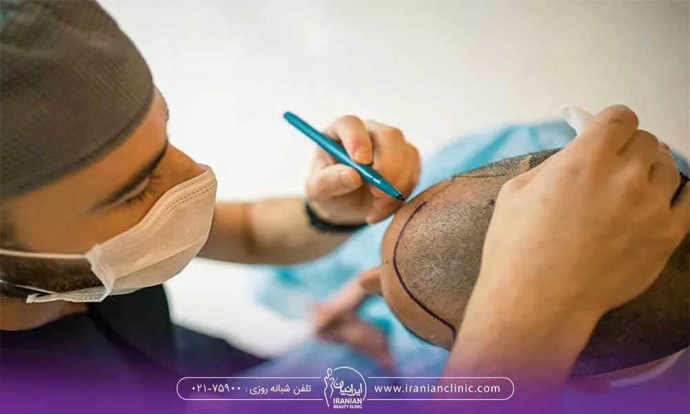 تصویر متخصص کاشت مو در حال ترسیم خط رویش با ماژیک روی سر مراجعه کننده مرد - کاشت مو برای موهای کم پشت