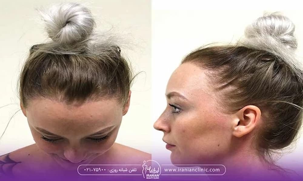 تصویر قبل و بعد کاشت مو مرجعه کننده زن - کاشت مو زنان پیشانی بلند