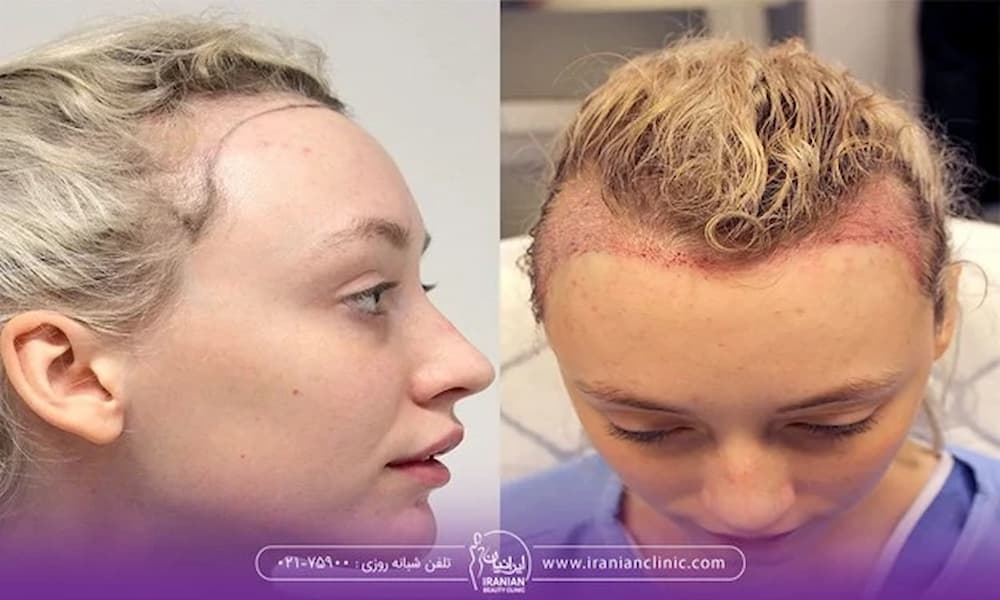 تصویر قبل و بعد کاشت مو مراجعه کننده با پیشانی بلند - کاشت مو زنان پیشانی بلند