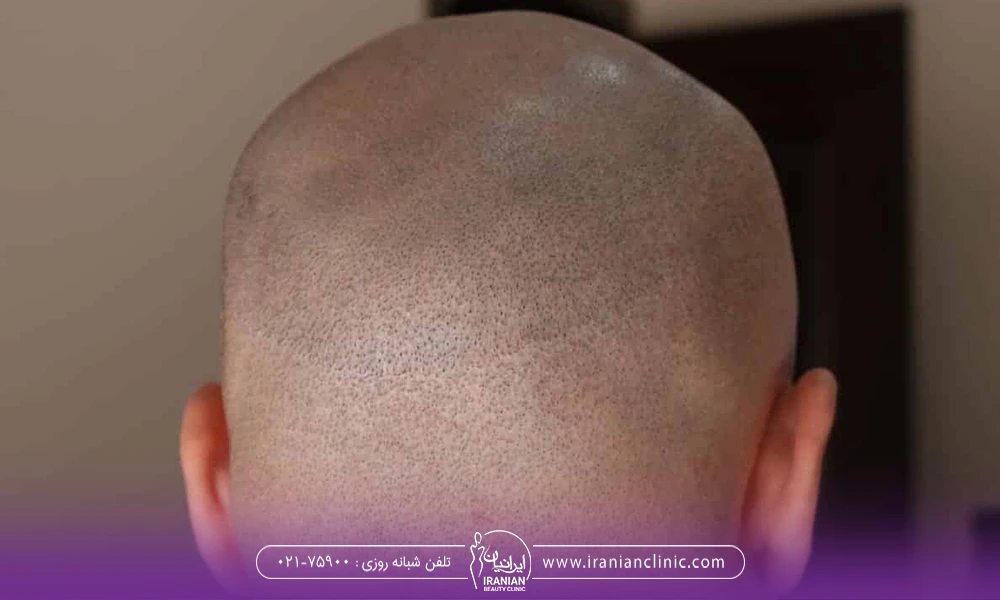مردی که سر خود را برای کاشت مو تراشیده است - ایا برای کاشت مو باید کچل کرد