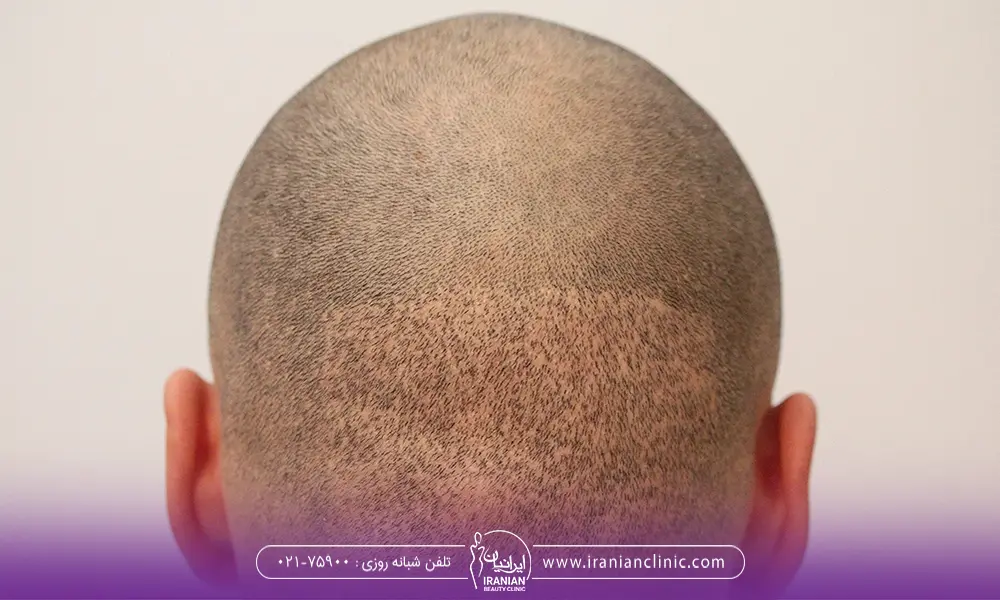 تصویر مراجعه کننده مرد بعد از کاشت مو - ایا امکان دارد موهای کاشته شده رشد نکنند