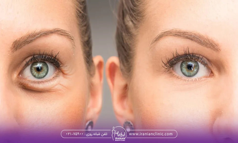 عکس قبل و بعد تزریق ژل به مراجعه کننده خانم - برای زیر چشم تزریق ژل بهتر است یا چربی؟