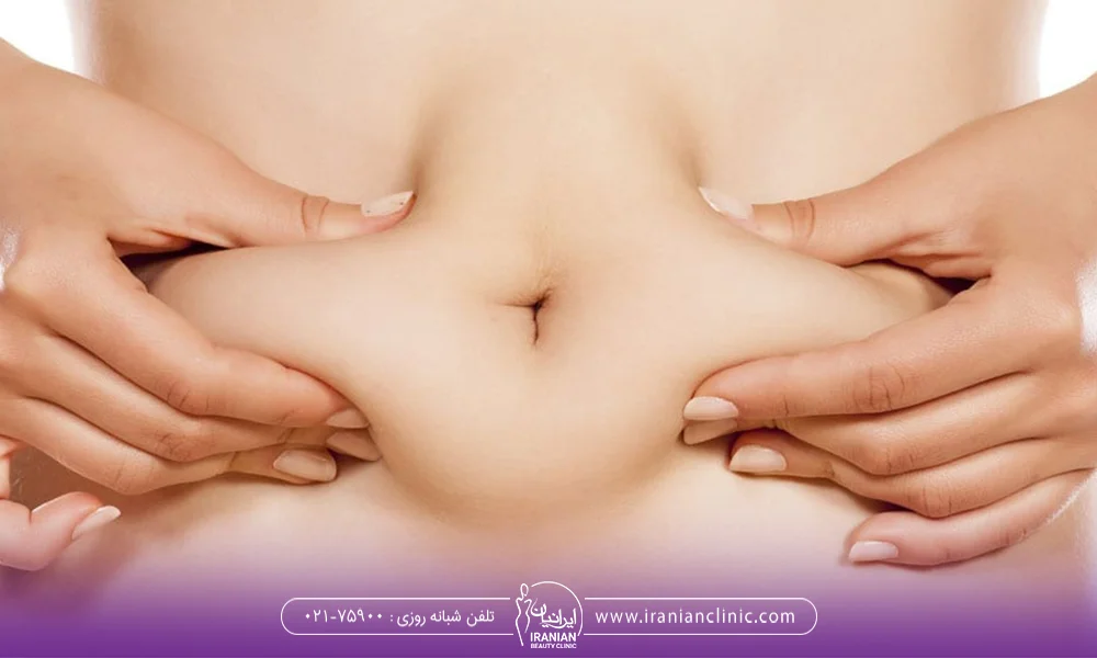 تصویر خانمی که چربی شکم خود را نگه داشته است - لیپوساکشن