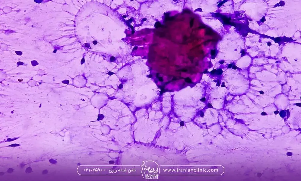 تصویر میکروسکوپی نکروز چربی بعد از تزریق چربی