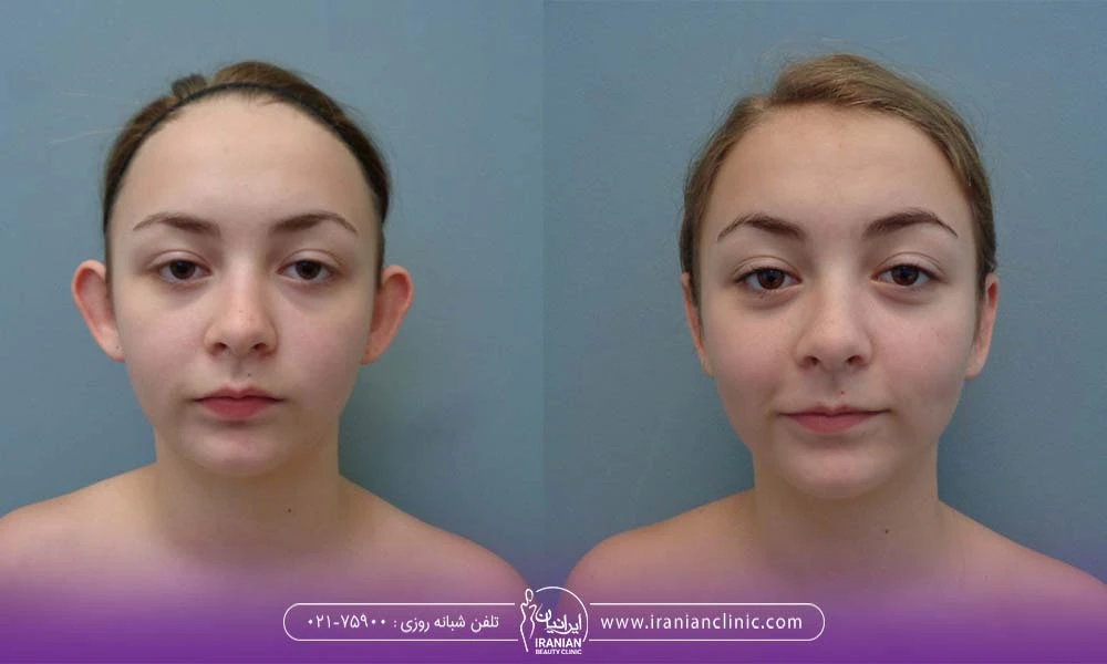 تصویر قبل و بعد جراحی زیبایی گوش
