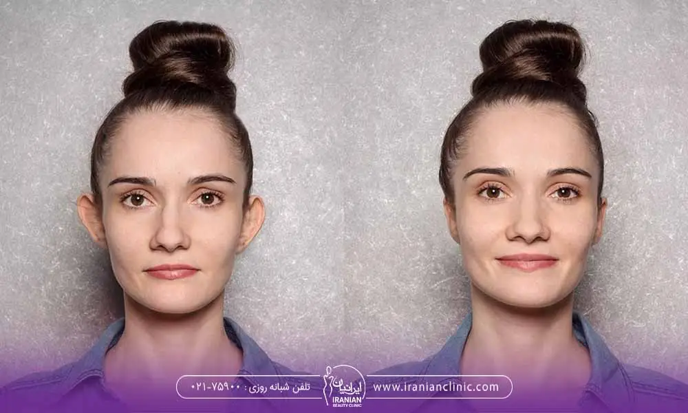 تصویر خانمی که بخاطر سایز گوش‌هایش از جراحی زیبایی گوش استفاده کرده است.