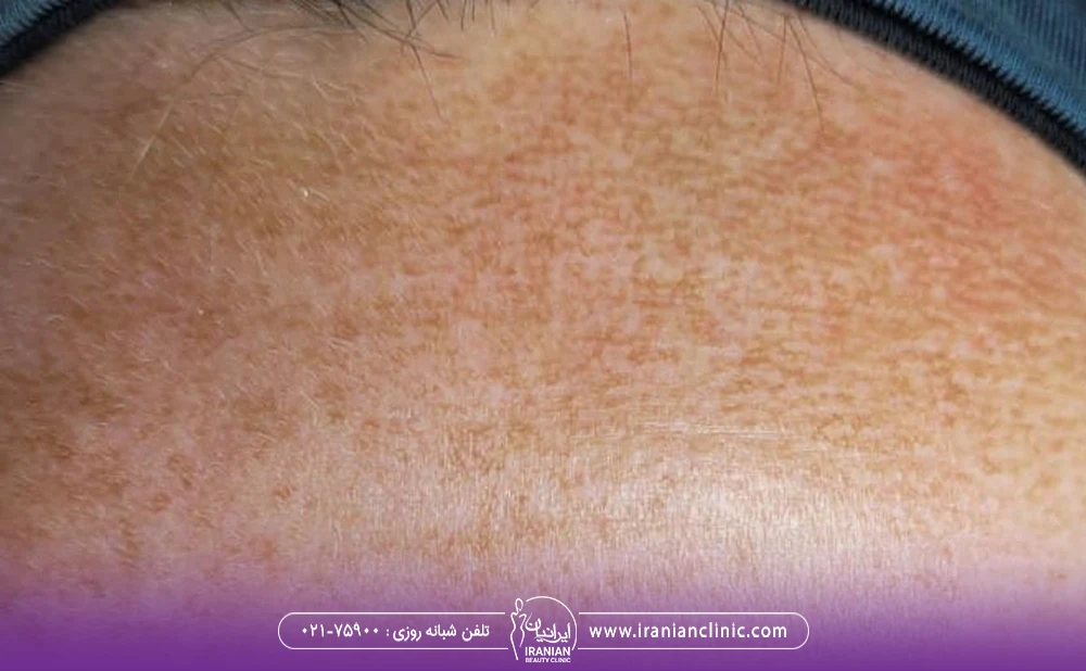 تیرگی پوست بعد از لیزر