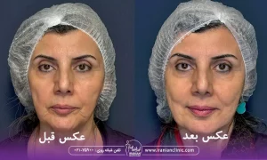 عکس قبل و بعد هایفوتراپی، عکس خانمی در حال لبخند بعد از هایفوتراپی