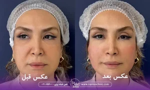 عکس خانمی که هایفوتراپی صورت انجام داده در کلینیک زیبایی ایرانیان