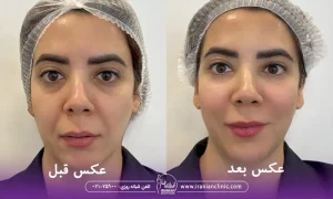 عکس قبل و بعد خانمی که هایفوتراپی انجام داده در کلینیک زیبایی ایرانیان